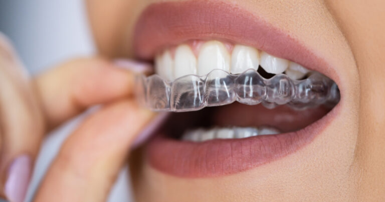 invisalign e guaiba
