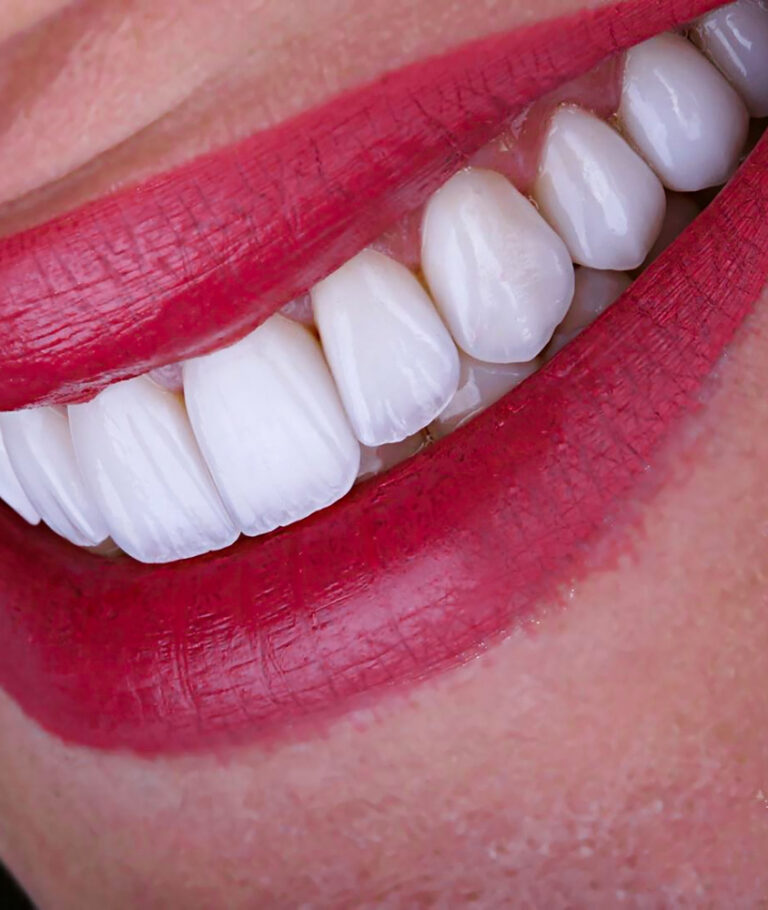Facetas de Porcelana em Guaíba o que é faceta de porcelana